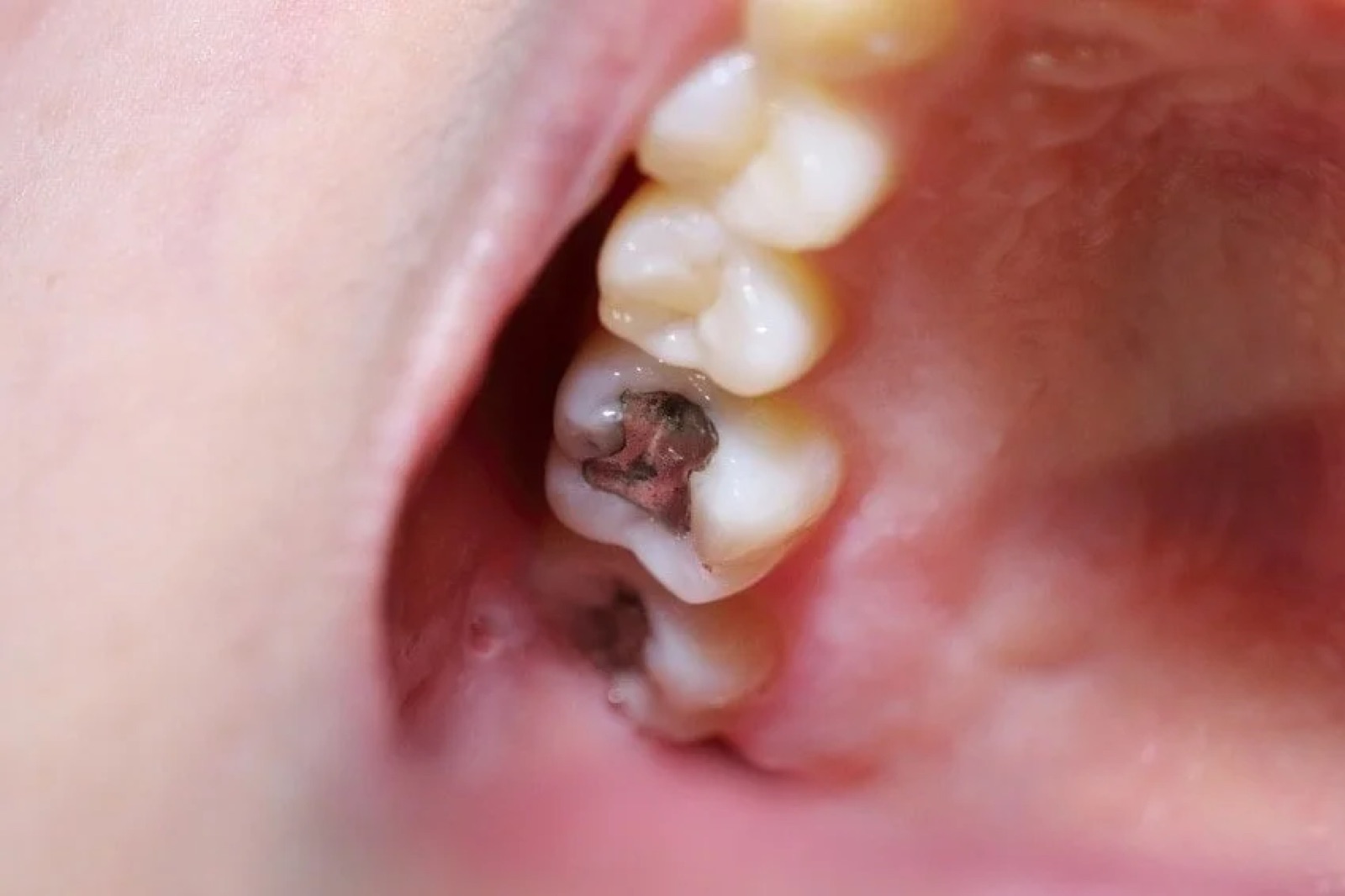 Tooth with amalgam filling – illustration in the context of chelation therapy and naturopathy