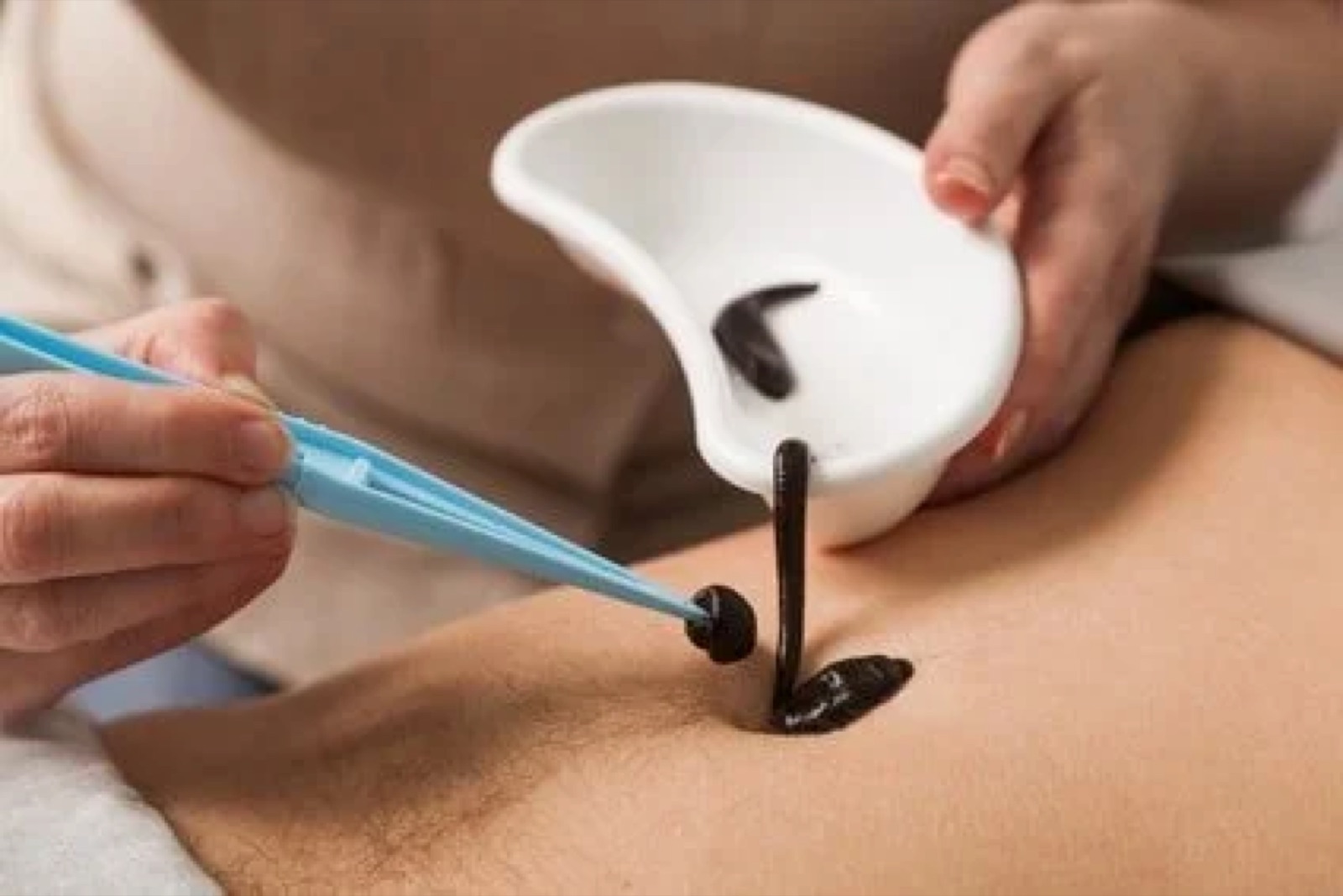 One person receiving acupuncture treatment with black needles while another person holds a white bowl containing a black substance.