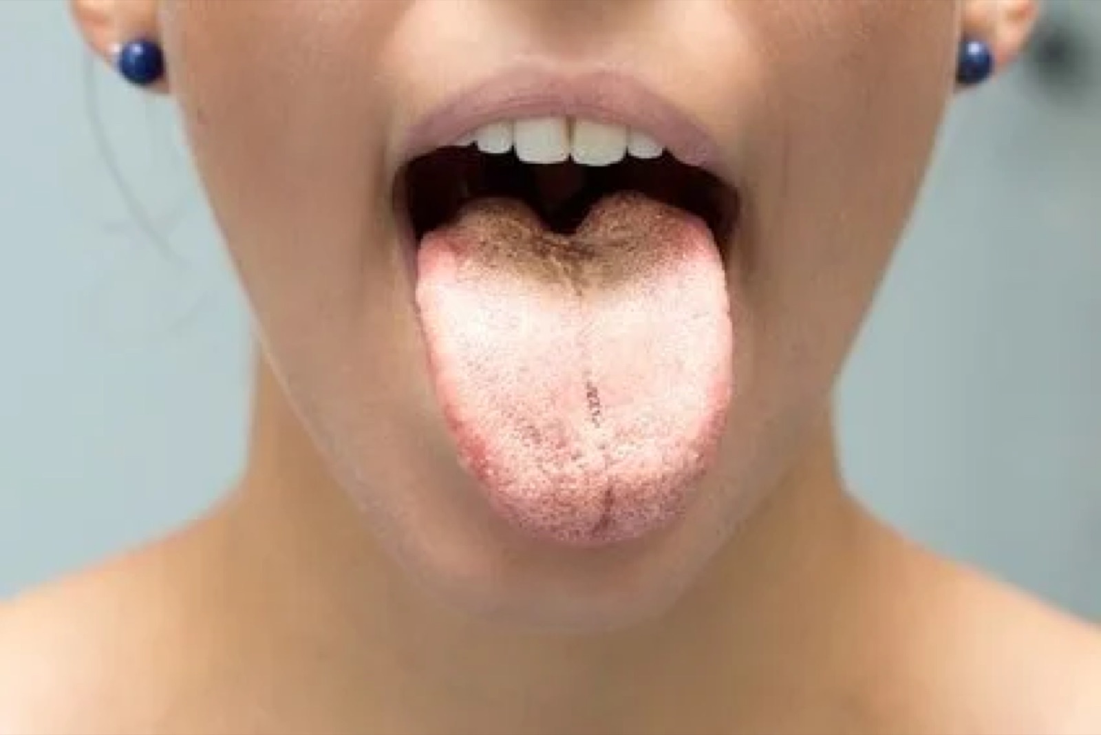 Tongue with a whitish coating in a young woman – illustrative image in the context of a possible Candida colonization, shown for information