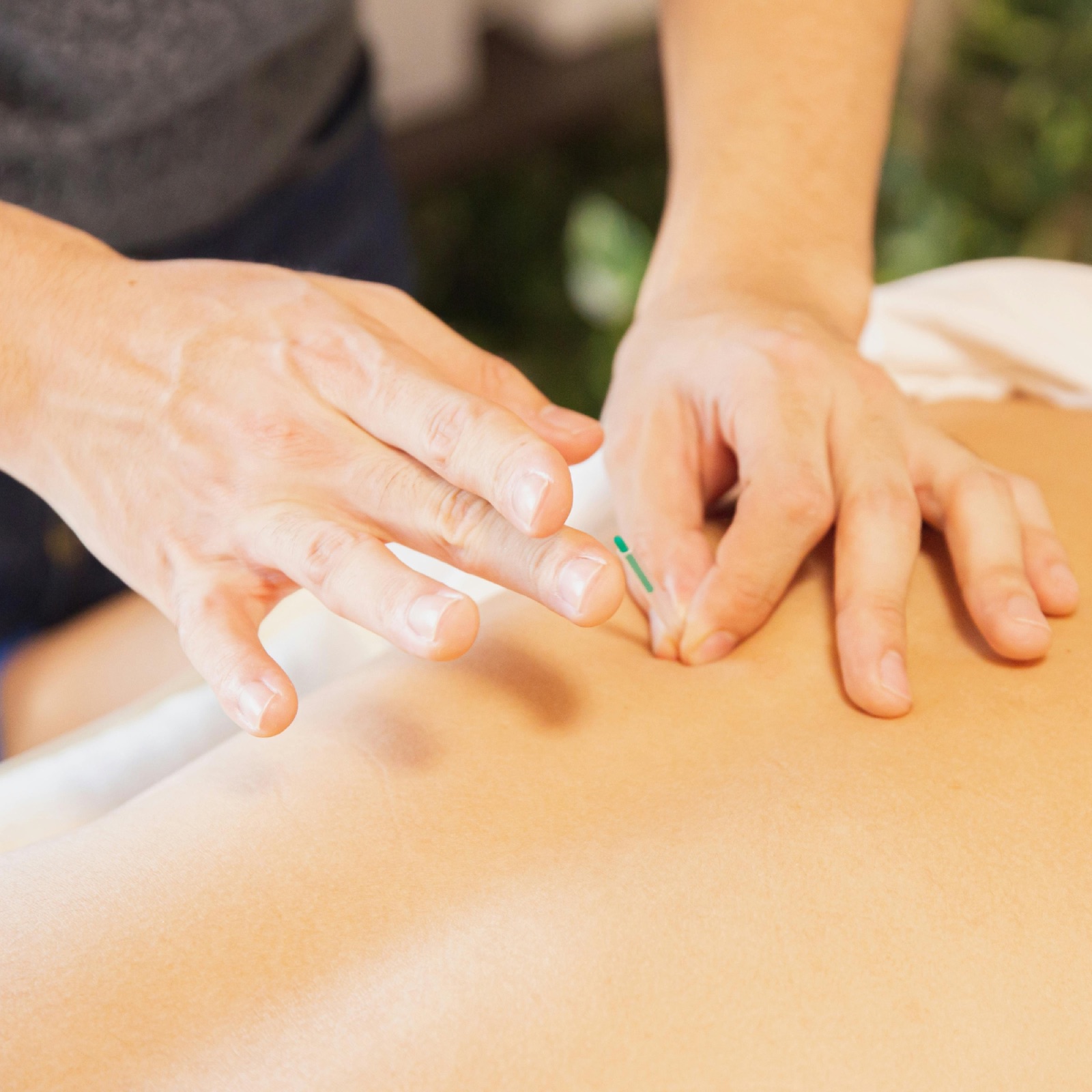 Dry needling with a naturopathic practitioner in Berlin