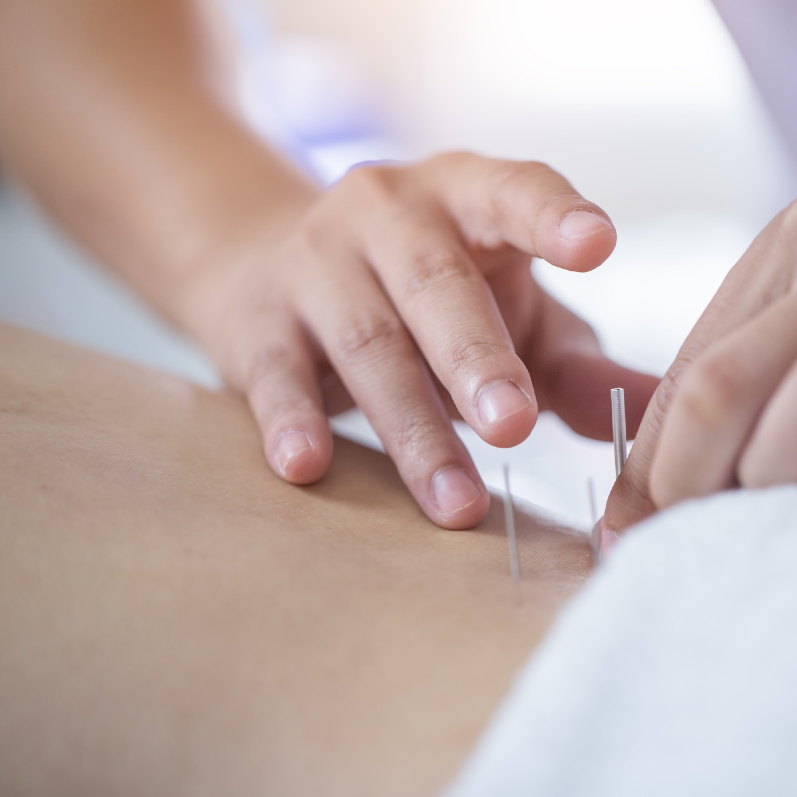Dry needling combined with physiotherapy at Natura Heilpraxis Berlin