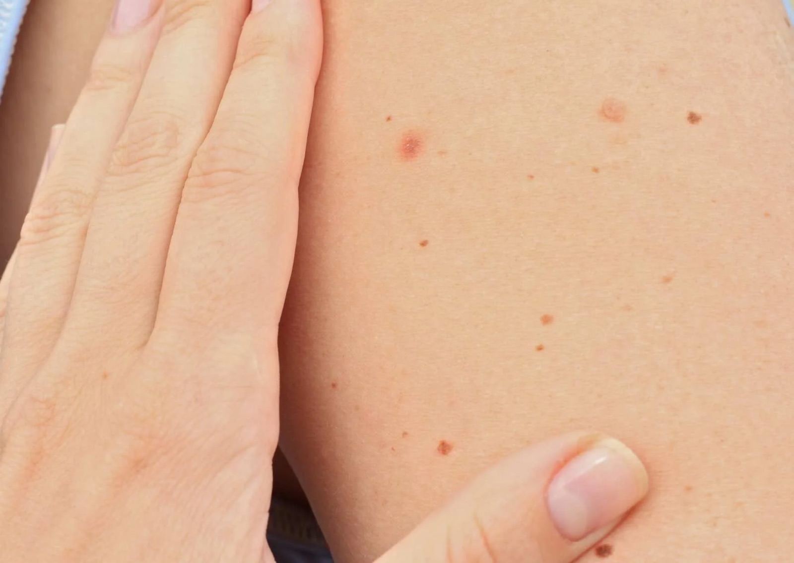 Close-up of skin with several moles and a hand touching the skin.