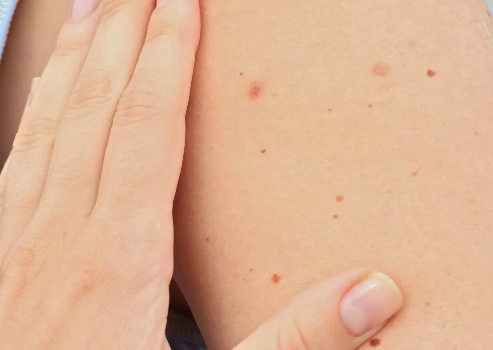 Nahaufnahme von Haut mit mehreren Muttermalen und einer Hand, die die Haut berührt.