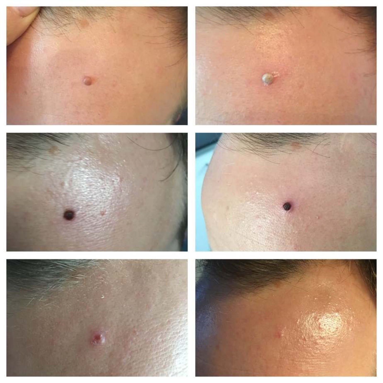 Six close-ups of skin with pimples, four on the face and two on the body.