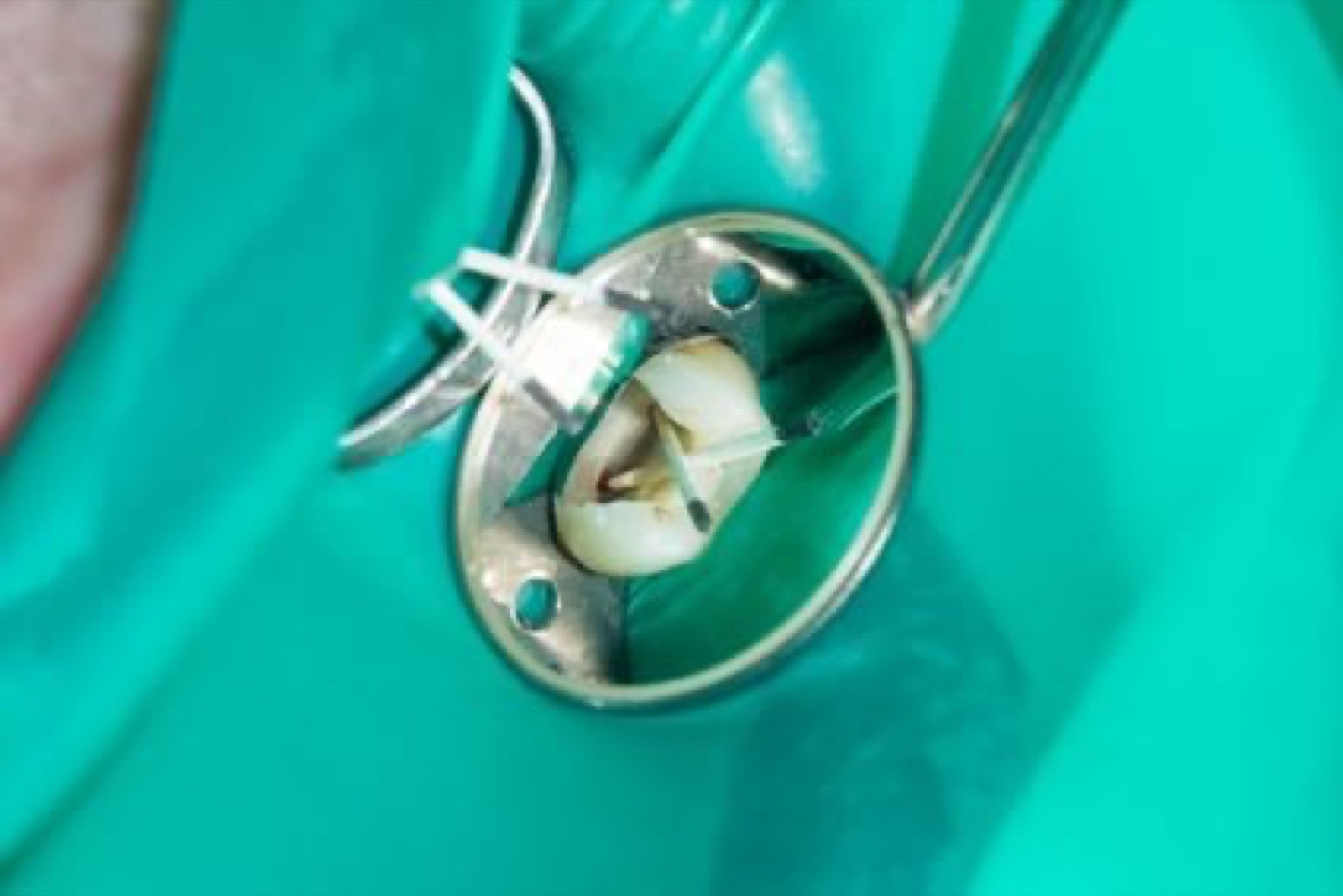 Amalgam removal with rubber dam, naturopathic practitioner (Heilpraktiker) Berlin